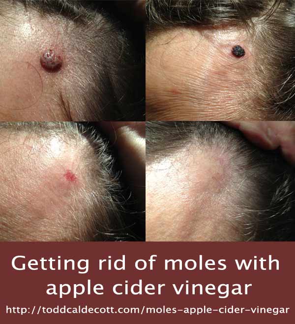 Moles ACV