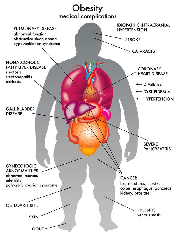 Medical-Complications-Of-Obesity