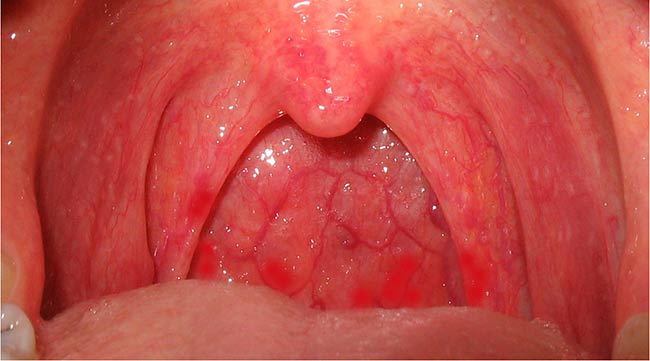A Healthy Throat 116