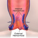 Hemorrhoids