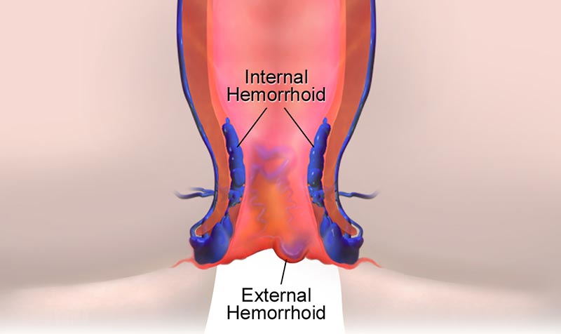 Hemorrhoids