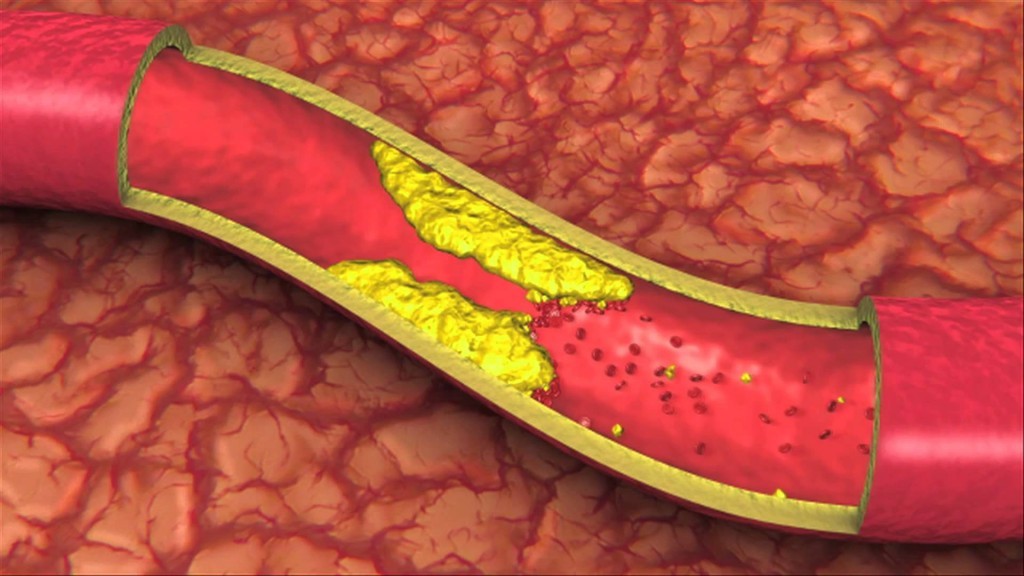 The Foods That Prevent Clogged Arteries Extreme Natural Health News