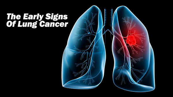 lung-cancer