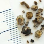 Kidney Stones