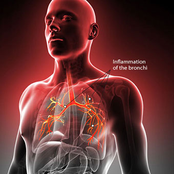 Bronchitis