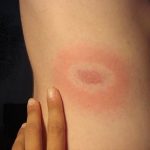 lyme_disease_rash