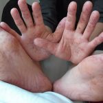 Hand, Foot and Mouth Disease