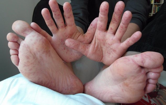 Hand, Foot and Mouth Disease