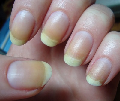 Yellow Nails